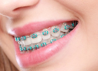 A mouth with braces in Parsippany