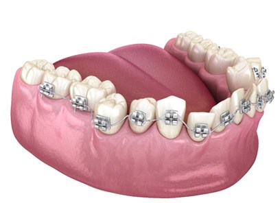 Dental braces on crooked teeth in Parsippany