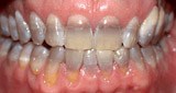 Severely decayed and discolored smile before porcelain veneers