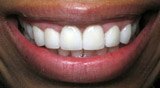 Corrected appearance of front teeth after porcelain veneers