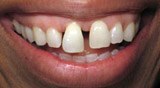 Smile with oversized and excessively spaced front teeth before porcelain veneers