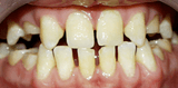 Yellowed and worn teeth before porcelain veneers