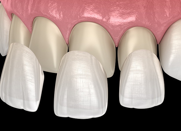 Animated smile with porcelain veneers placed on row of front teeth