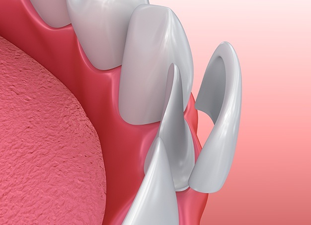 Animated smile during placement of a single porcelain veneer