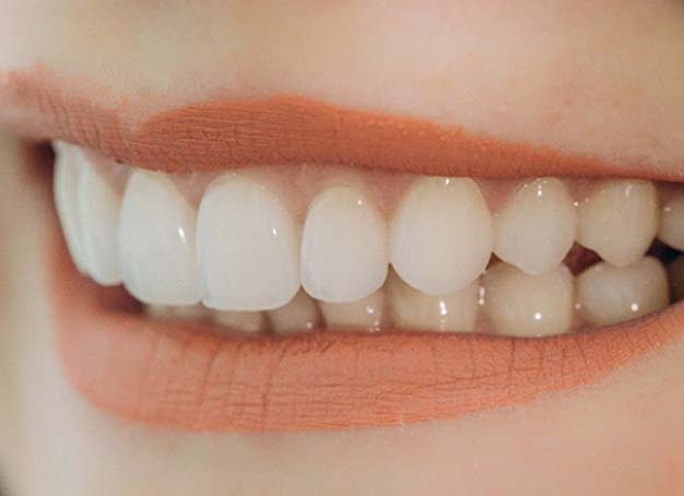 Woman smiling with veneers in Parsippany