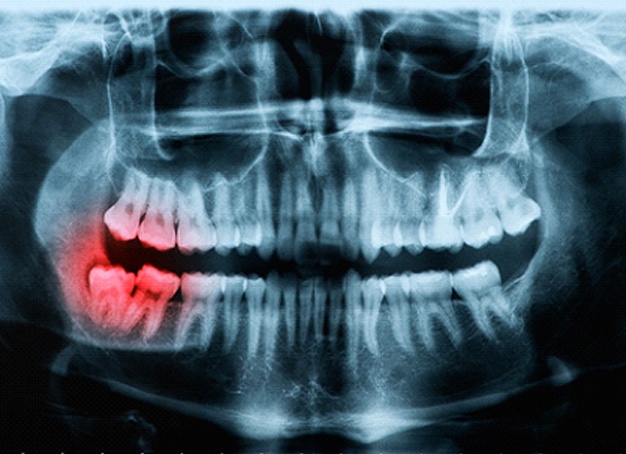 X-ray shoring wisdom teeth in Parsippany, NJ pushing molars