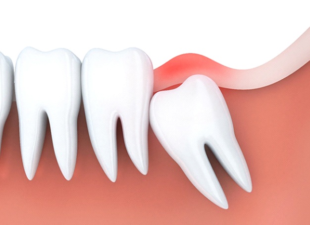 Illustration of an impacted wisdom tooth in Parsippany, NJ