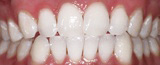 Closeup bright smile after teeth whitening