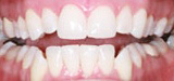 Closeup brilliant smile after teeth whitening