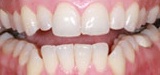 Closeup imperfect smile before teeth whitening