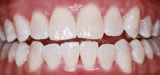 Brilliant smile closeup after teeth whitening