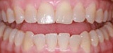 Discolored smile closeup before teeth whitening