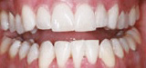 Closeup smile after teeth whitening