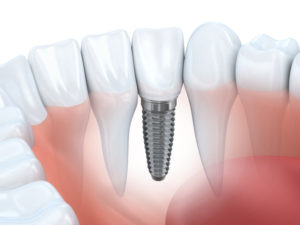 dental implants in parsippany