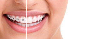 woman with braces smiling