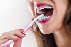 A girl with braces brushing her teeth.