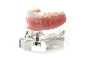 A denture resting on implants
