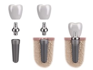 parts dental implant