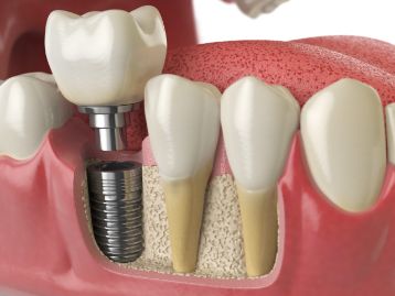 Dental implant in the lower jaw