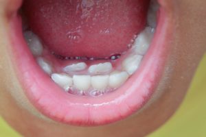 Closeup of example of two rows of teeth in kids