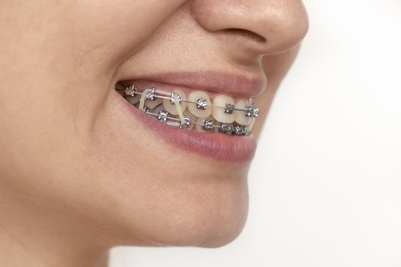 an up-close image of a person wearing rubber bands on braces in Parsippany