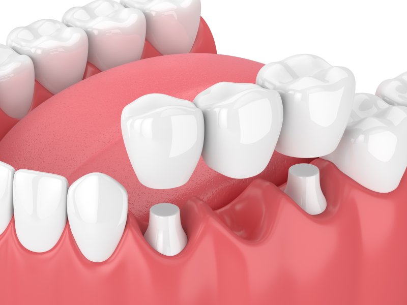 illustration of a dental bridge in Parsippany