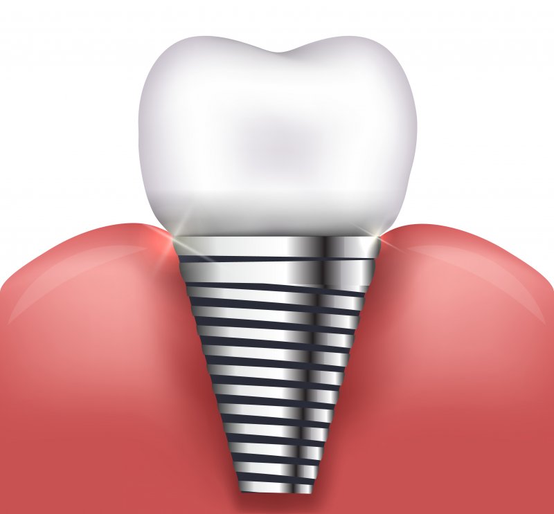 illustration of dental implant in Parsippany