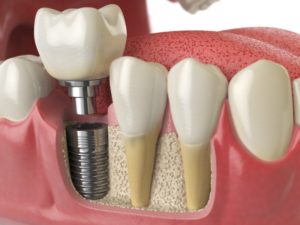 dental implants illustration 