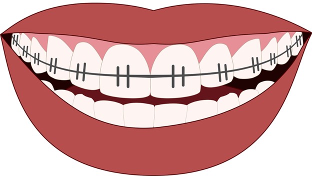 Cartoon drawing of mouth with braces on top row of teeth.