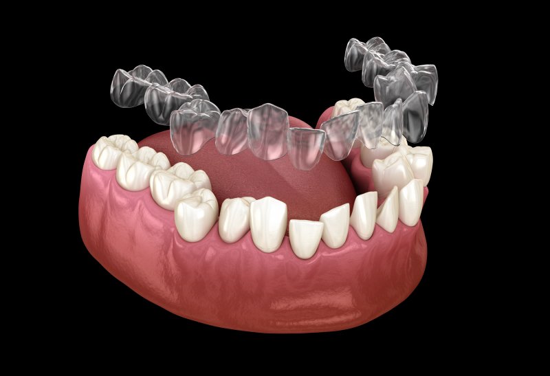3-D model of Invisalign aligners fitting over teeth