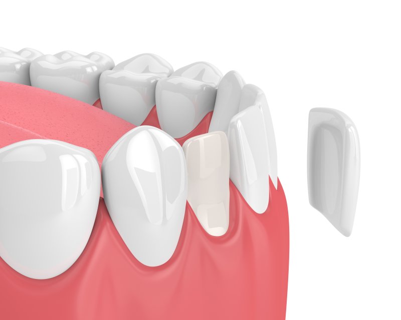 3-D model of a veneer coming off of a tooth