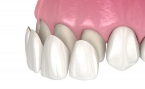 3D illustration of applying veneers 