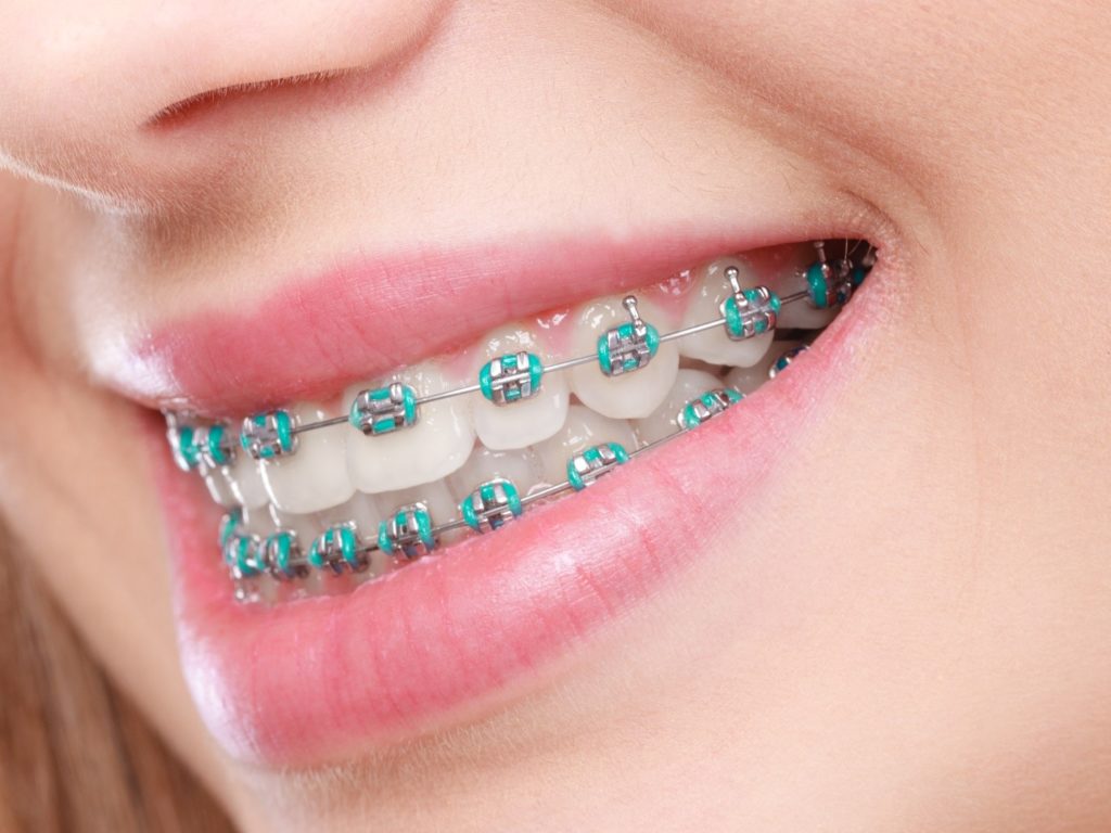 a patient with braces smiling