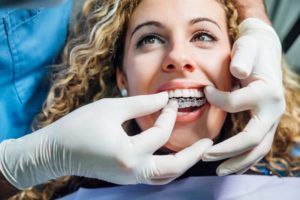 a dentist placing Invisalign refinements in a patient’s mouth