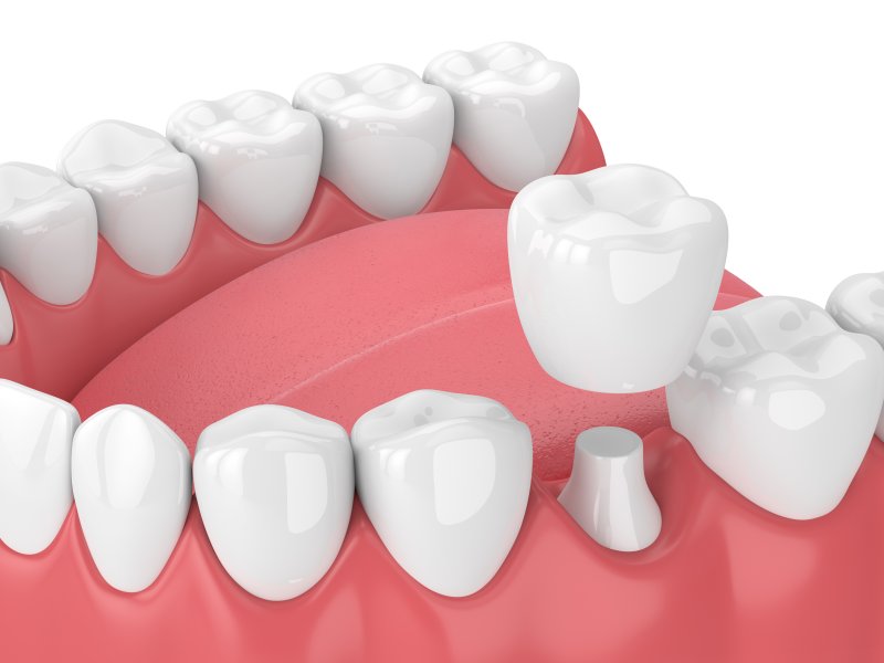 3D render of a dental crown on a tooth