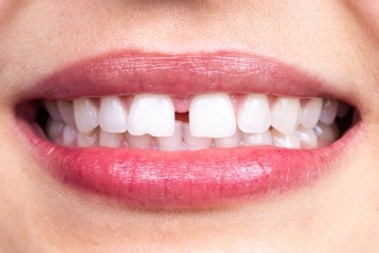 closeup of smile with diastema 