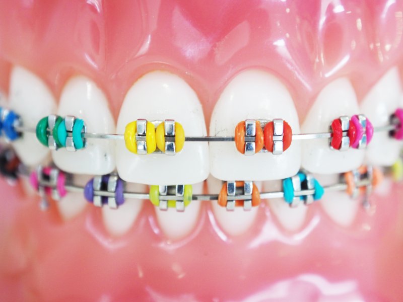Patient smiling with colorful braces