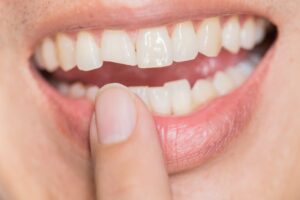 Person with a broken tooth
