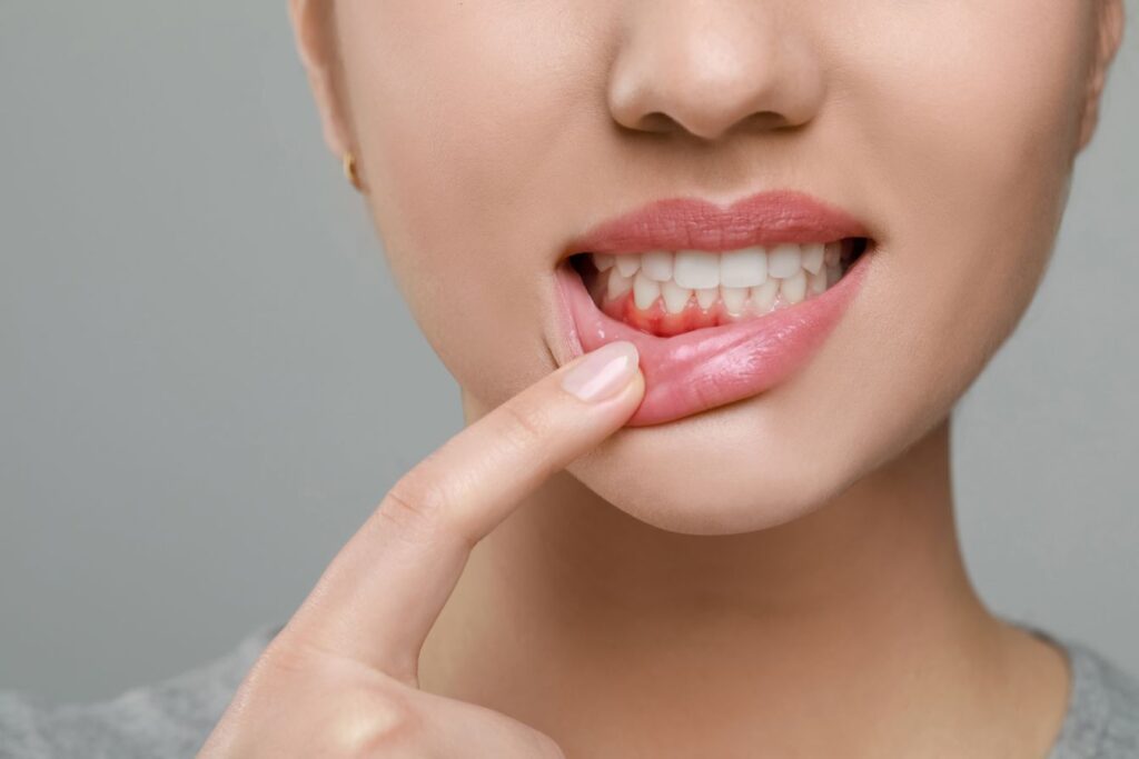 A woman with gum disease