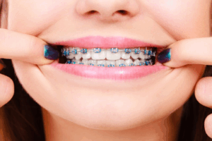 Woman pulling back her lips to reveal traditional braces