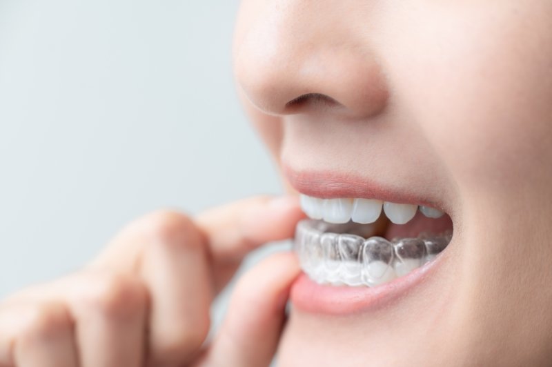 person inserting an Invisalign aligner