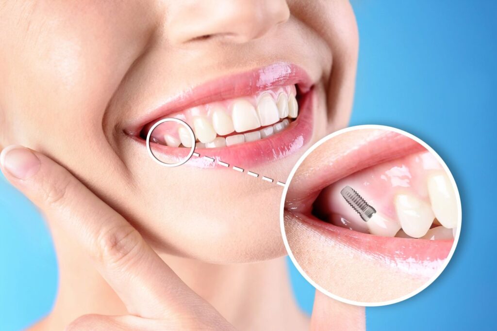 Nose-to-chin view of woman smiling touching chin with tooth indicated as implant