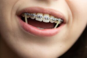 Woman wearing rubber bands on her braces
