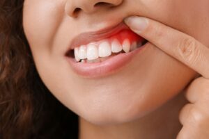 Woman with red gums